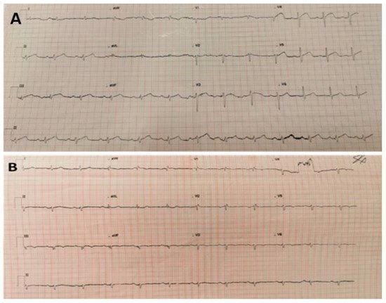 Cardiogenetics, Vol. 12, Pages 246-252: Recurrent Episodes of Acute Myocardial Infarction Secondary to Paradoxical Coronary Artery Embolism