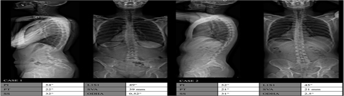 Sagittal Balance Using Position and Orientation of Each Vertebra in an Asymptomatic Population