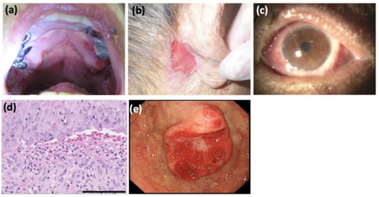 Dermatopathology, Vol. 9, Pages 287-291: A Case of IgG and IgA Anti-Laminin-332 Antibody-Positive Mucous Membrane Pemphigoid with IgG and IgA Anti-Envoplakin and Anti-Periplakin Antibodies