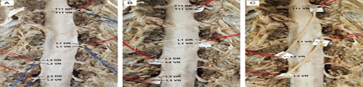 Extradural Contralateral Ventral Root Transfer to Treat Lower Limb Motor Dysfunction in Paraplegia