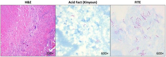 Diseases, Vol. 10, Pages 96: Pulmonary Granulomas and Mycobacterial Infection: Concordance between the Results of Special Stains Performed on Lung Tissue Sections and Tissue Cultures