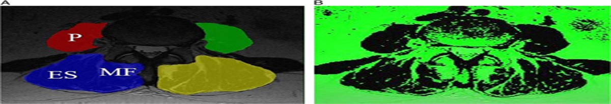 Preoperative Association Between Quantitative Lumbar Muscle Parameters and Spinal Sagittal Alignment in Lumbar Fusion Patients