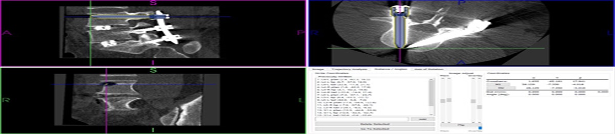Factors Affecting the Accuracy of Pedicle Screw Placement in Robot-Assisted Surgery: A Multicenter Study