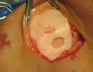 Evidence-Based Approach to Orthobiologics for Osteoarthritis and Other Joint Disorders