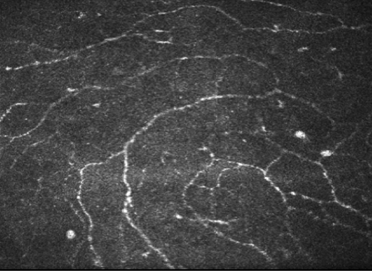 Impact of Peripheral and Corneal Neuropathy on Markers of Ocular Surface Discomfort in Diabetic Chronic Kidney Disease