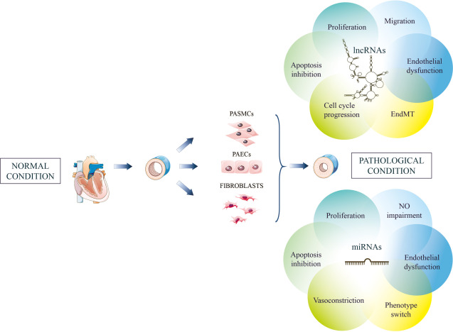 Noncoding RNAs in Pulmonary Arterial Hypertension