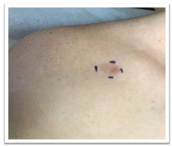 Dermatopathology, Vol. 9, Pages 379-384: Atrophic Dermatofibrosarcoma Protuberans with Eosinophilic Infiltration