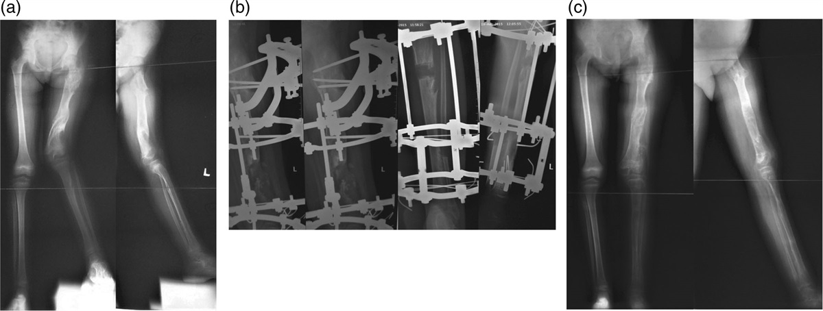 Outcomes of intralesional osteotomy and distraction osteogenesis for limb length equalization in Ollier’s disease