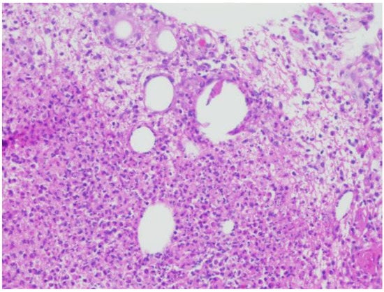 Dermatopathology, Vol. 9, Pages 408-412: Cystic Neutrophilic Granulomatous Mastitis Treatment with Consecutive Dapsone and Adalimumab