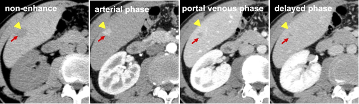 A Case Review on Combined Hepatocellular Cholangiocarcinoma