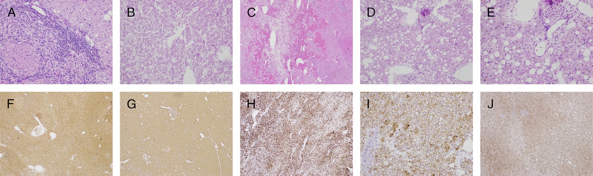 Hepatocellular Adenoma: A Case Report, Current Updates on Subtyping, and Diagnostic Pitfalls