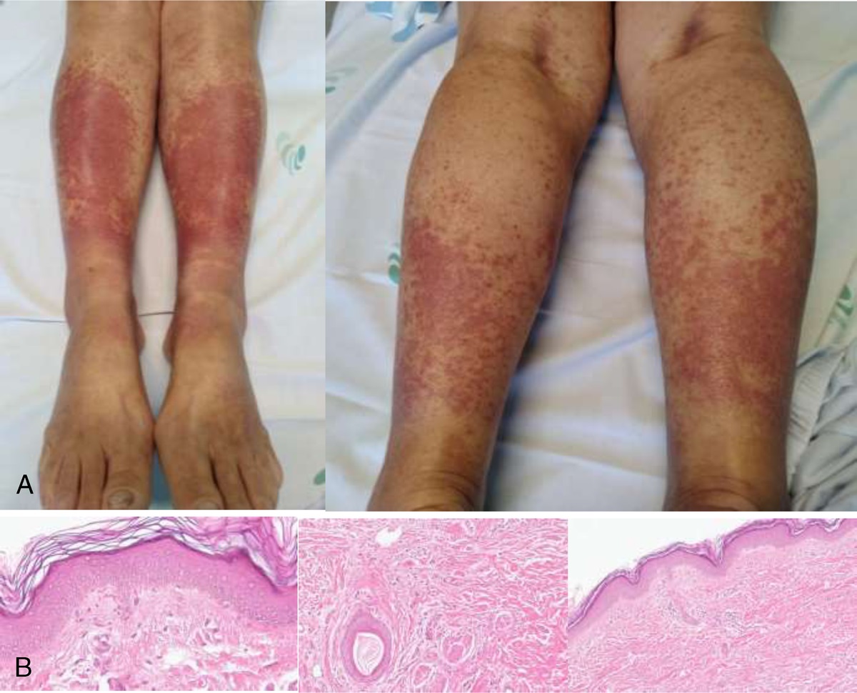 A Rare Reaction Due to COVID-19 Vaccination