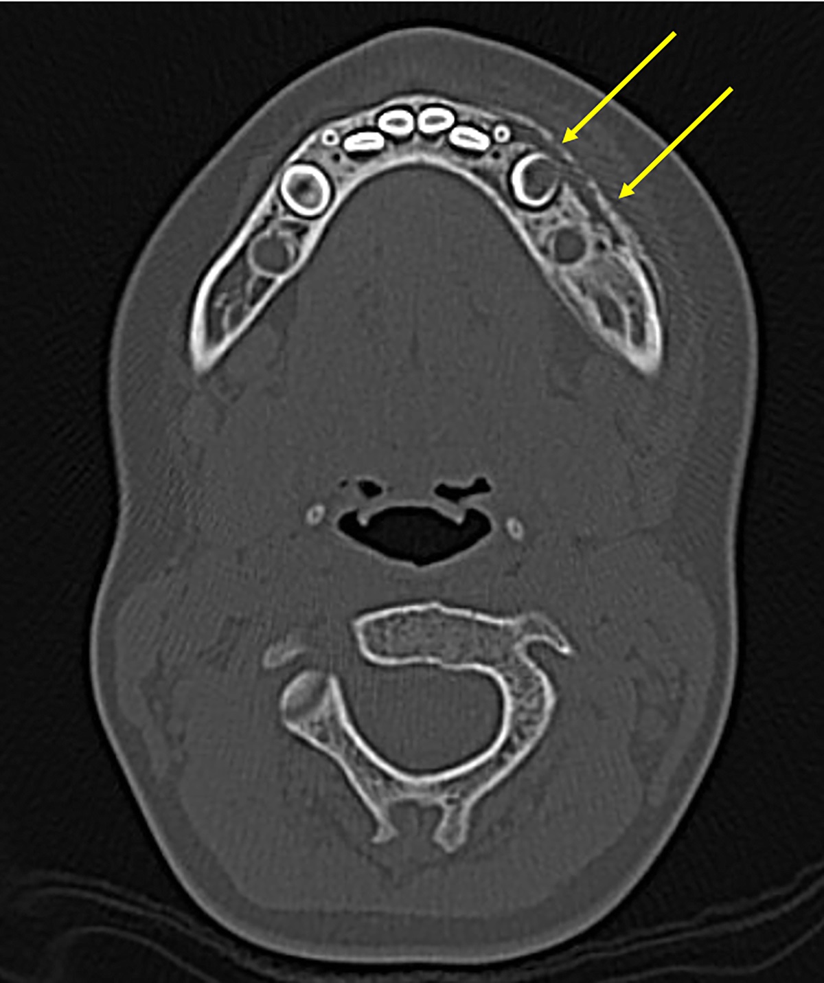 A Bone-on-Bone Appearance in Chronic Nonbacterial Osteomyelitis