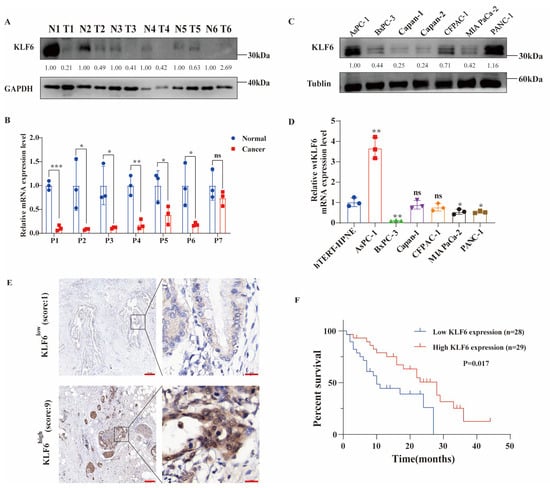 JCM, Vol. 12, Pages 200: Krüppel-like Factor 6 Suppresses the Progression of Pancreatic Cancer by Upregulating Activating Transcription Factor 3