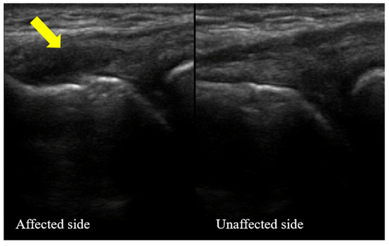 JPM, Vol. 13, Pages 66: Ultrasound-Guided Injection of Autologous Platelet-Rich Plasma for Refractory Lateral Epicondylitis of Humerus: Case Series