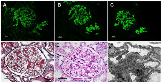 Cells, Vol. 12, Pages 116: Glomerular Galactose-Deficient IgA1(KM55) Positive May Predict Poorer Prognosis in Coexisting Primary Membranous Nephropathy and IgA Nephropathy Patients