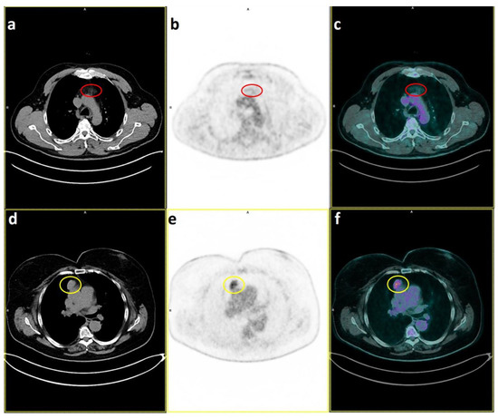 Diagnostics, Vol. 13, Pages 98: Is PET/CT Able to Predict Histology in Thymic Epithelial Tumours? A Narrative Review