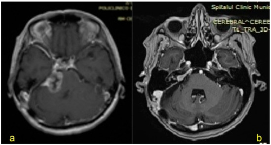 JPM, Vol. 13, Pages 76: Assessing the Efficacy of Anastomosis between Ansa Cervicalis and Facial Nerve for Patients with Concomitant Facial Palsy and Peripheral Neuropathy
