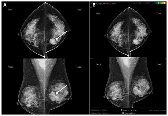 Diagnostics, Vol. 13, Pages 117: Comparison of Diagnostic Performance in Mammography Assessment: Radiologist with Reference to Clinical Information Versus Standalone Artificial Intelligence Detection
