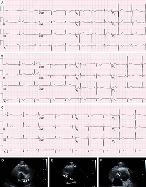 Case 40-2022: A 38-Year-Old Man with Exertional Chest Discomfort