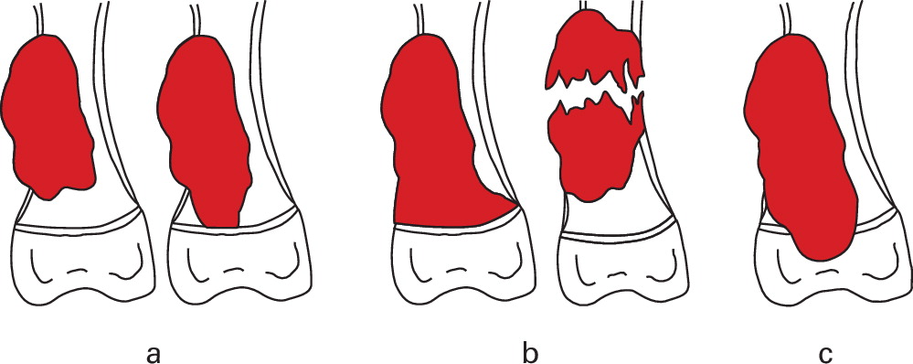 Epiphyseal distraction prior to resection in paediatric bone sarcomas