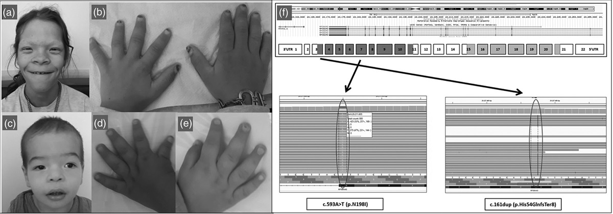 Novel RPS6KA3 mutations cause Coffin-Lowry syndrome in two patients and concurrent compulsive eyebrow-pulling behavior in one of them