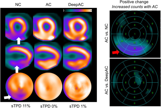 Artificial Intelligence in Nuclear Cardiology