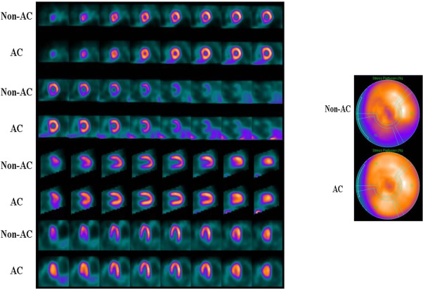 Stress-First Myocardial Perfusion Imaging