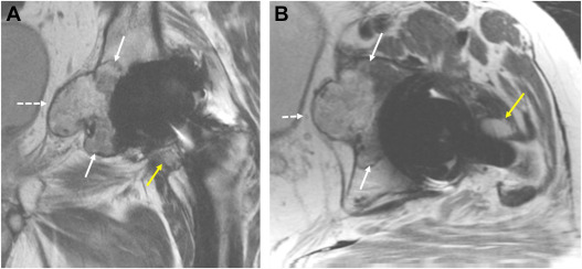 Pain After Hip Arthroplasty
