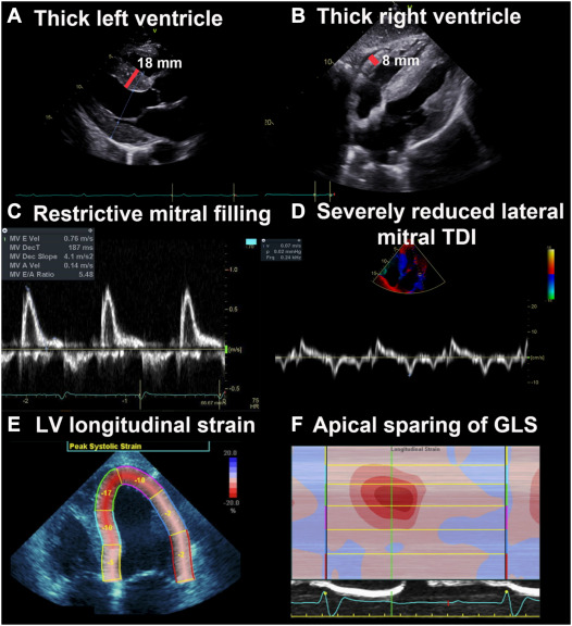 Current Status of Radionuclide Imaging of Transthyretin Cardiac Amyloidosis