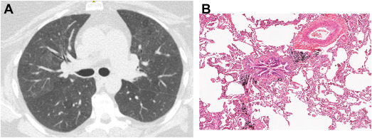 Smoking-Related Interstitial Lung Diseases