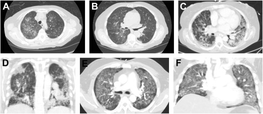 Drug-Induced Interstitial Lung Diseases