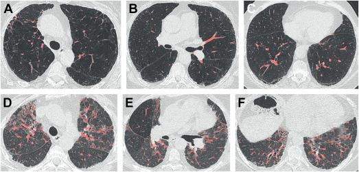 Clinically Relevant Biomarkers in Connective Tissue Disease-Associated Interstitial Lung Disease