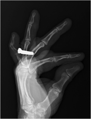 Management of Gout in the Hand and Wrist