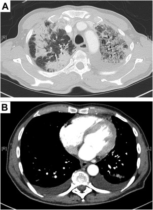 Eosinophilic Lung Diseases