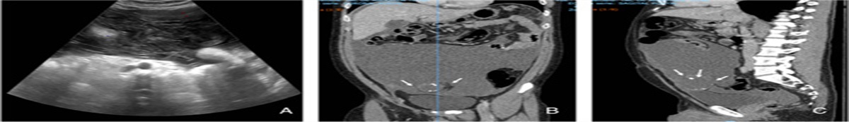 Mucinous adenocarcinoma of the urachus: a practical overview of a broad differential diagnosis: case report