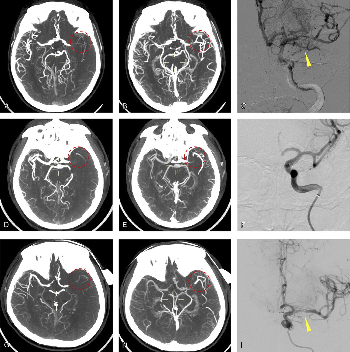 Effect of Truncal-Type Occlusion Based on Multiphase or Single-Phase Computed Tomographic Angiography in Predicting Intracranial Atherosclerotic Stenosis–Related Acute Middle Cerebral Artery Occlusion