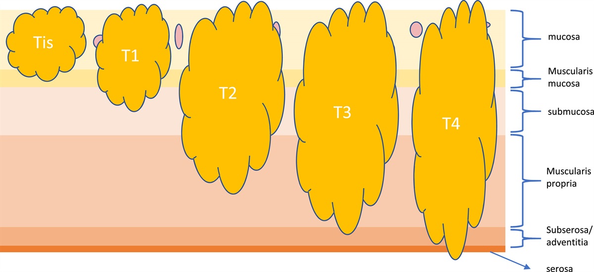 Current Challenges and Controversies in Colorectal Carcinoma Pathologic Staging—A Practical Guide