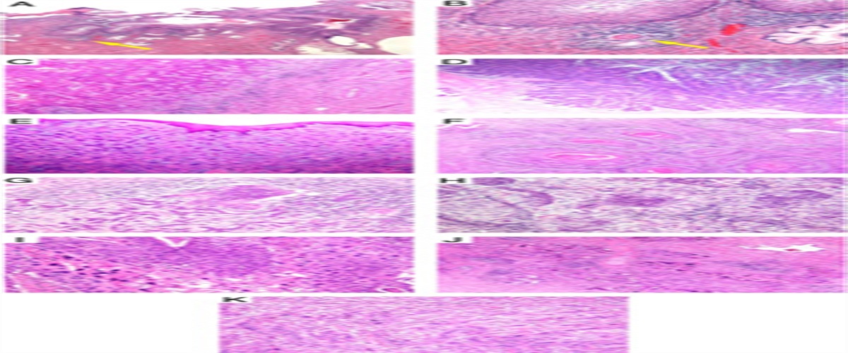 Invasive Squamous Cell Carcinoma of the Cervix: A Review of Morphological Appearances Encountered in Human Papillomavirus-associated and Papillomavirus-independent Tumors and Precursor Lesions