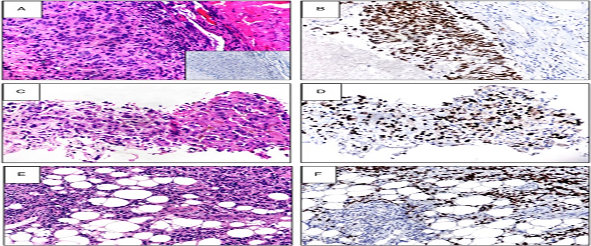 TRPS1, a New Promising Marker for Assessment of Distant Metastatic Breast Cancer
