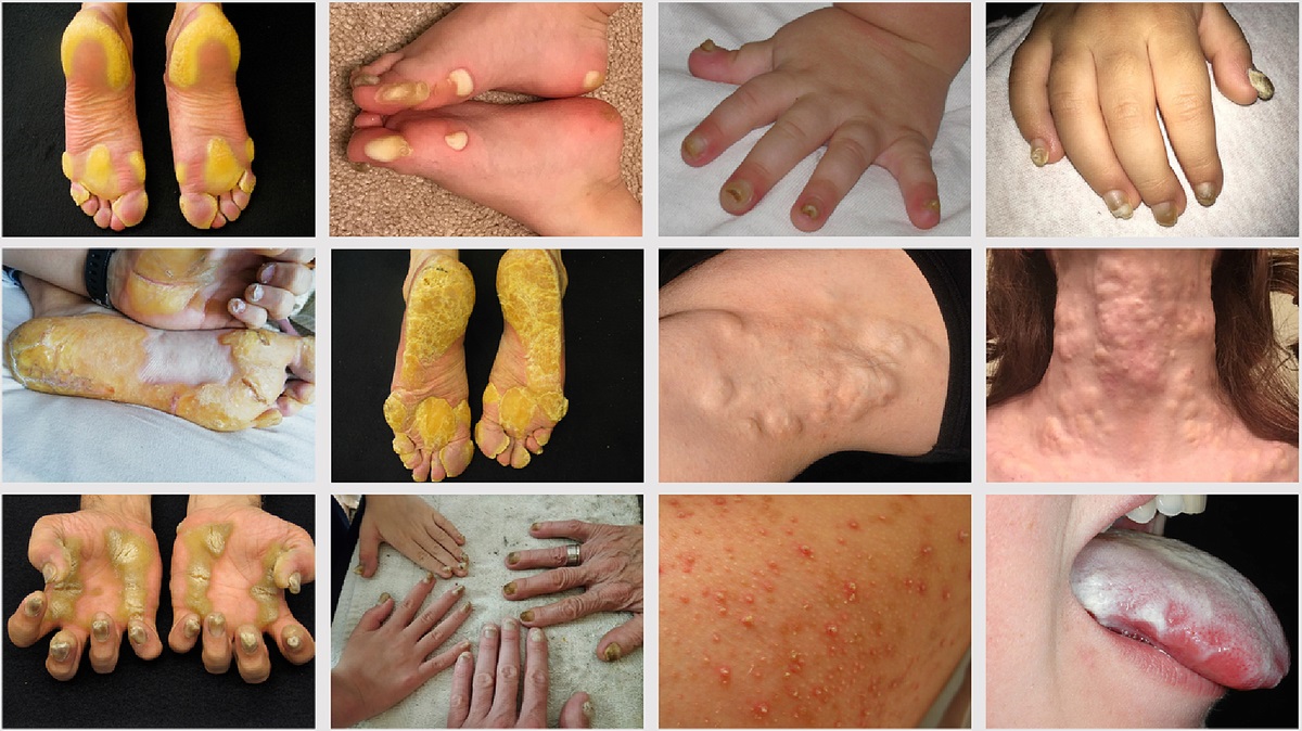 Patient Perspectives Column: The Pachyonychia Congenita Project