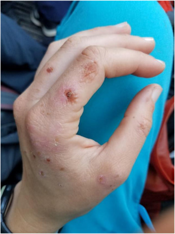 Sap and Sun: A Case of Phytophotodermatitis