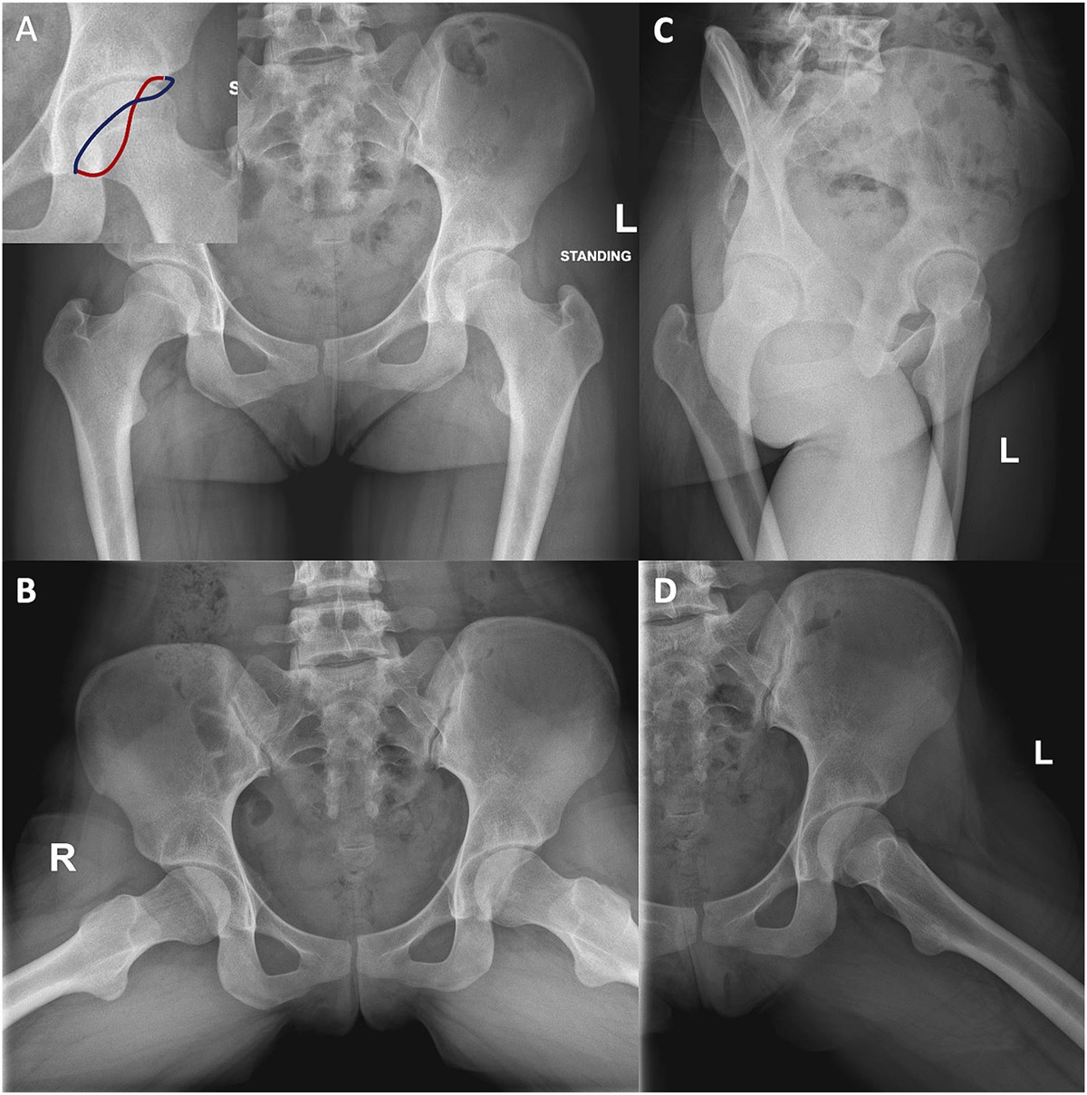 Team Approach: Hip Preservation Surgery