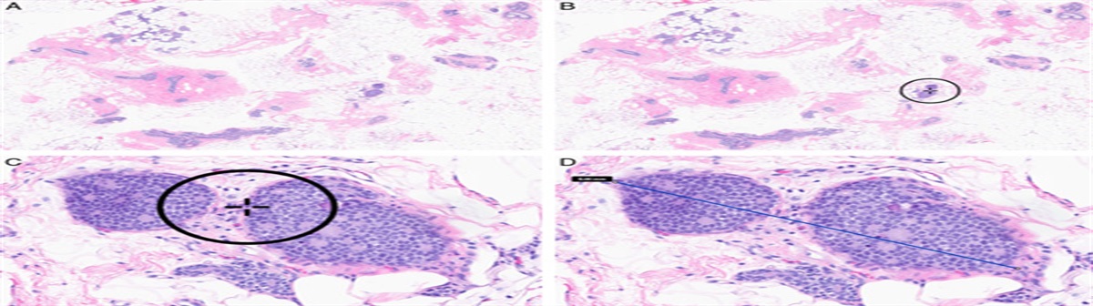 Future Practices of Breast Pathology Using Digital and Computational Pathology