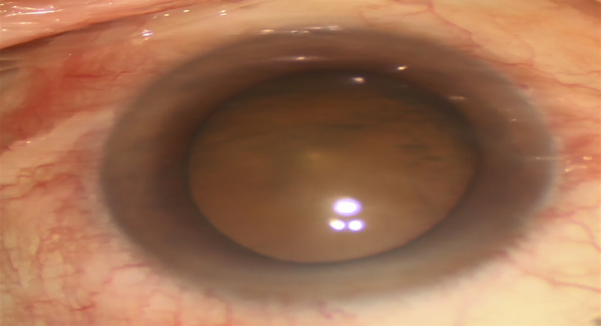 Risk Factors for Primary Angle-closure Glaucoma: A Systematic Review and Meta-analysis of 45 Studies