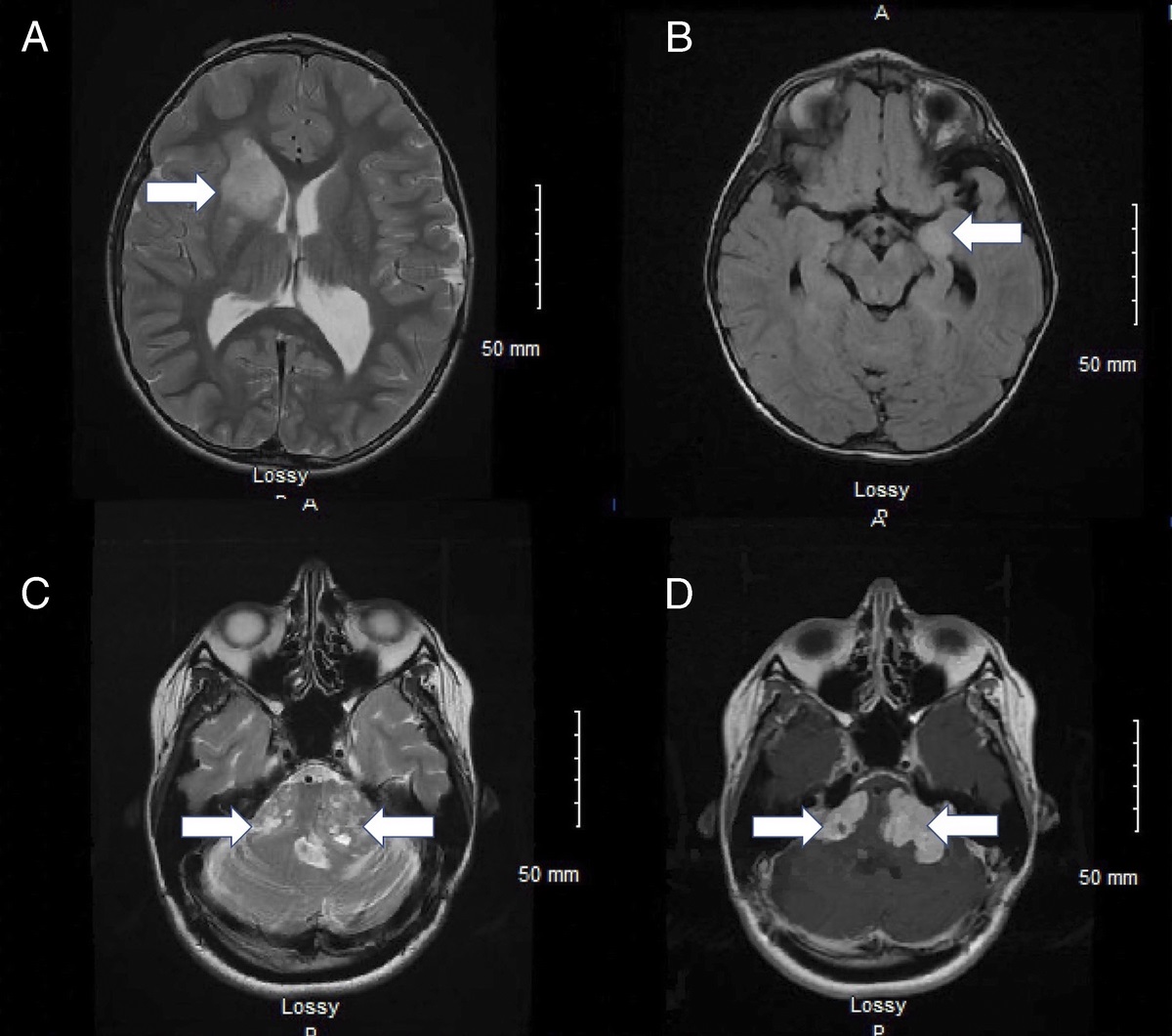 Neurocutaneous Disorders in Pregnancy