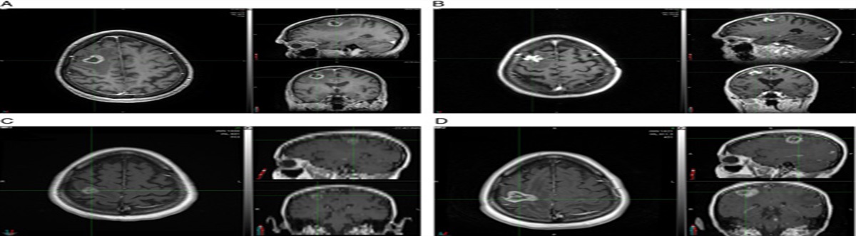 Differentiating Radiation Necrosis and Metastatic Progression in Brain Tumors Using Radiomics and Machine Learning