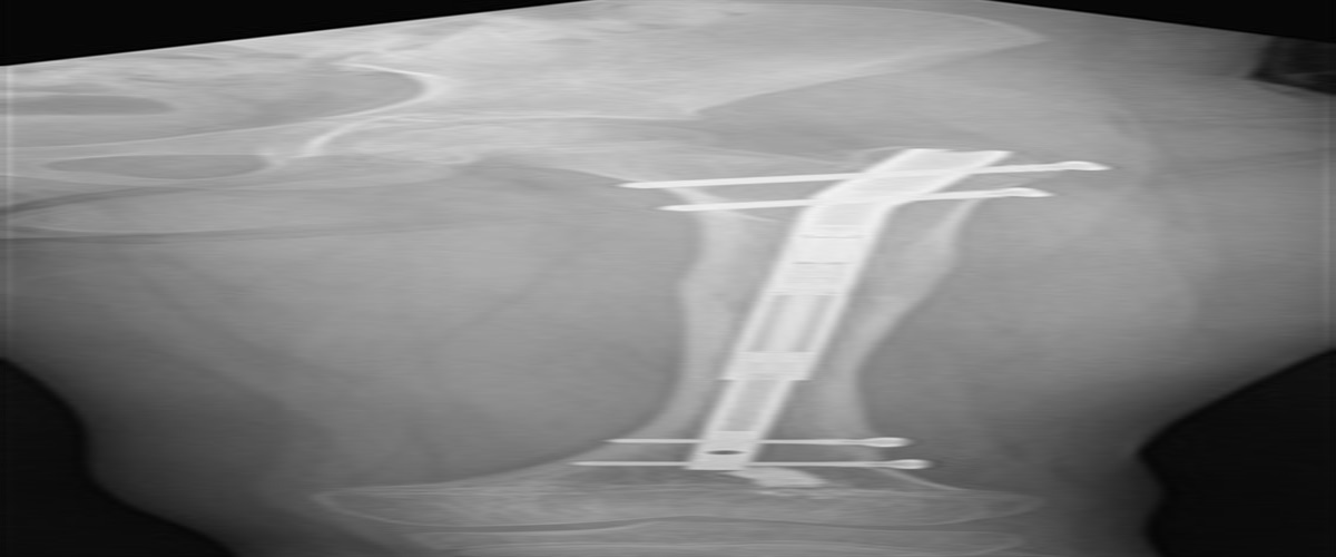Long Bone Lengthening in Children