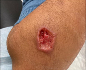 Young Migrant with Arm Ulcer