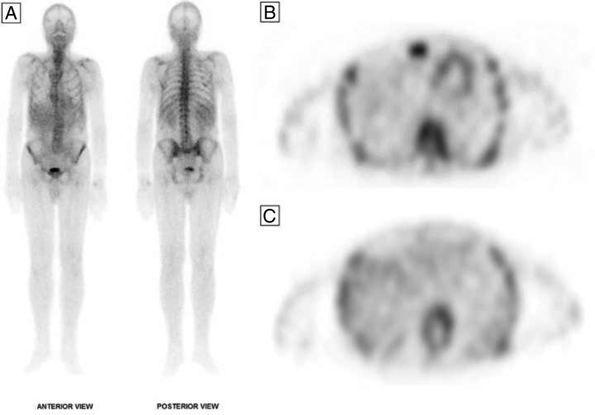 Randall-Type Monoclonal Immunoglobulin Deposition Disease in Bone Scintigraphy